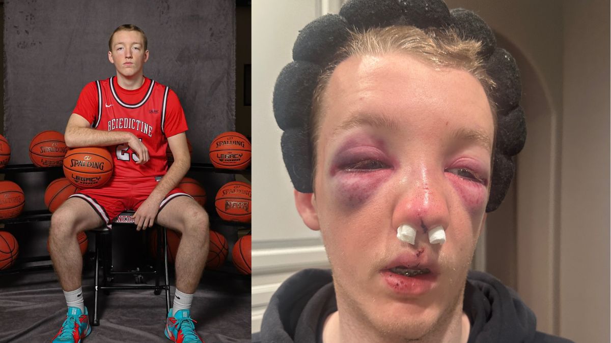 Chandler Native Dylan Alvidrez Suffers Severe Facial Injuries in Basketball Accident